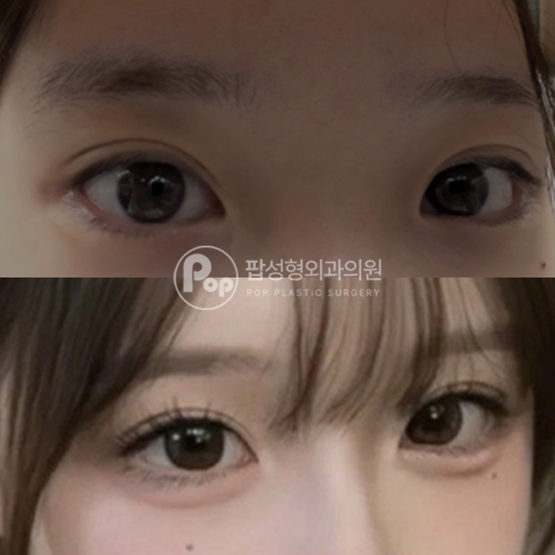 강남 팝성형외과 자연유착 눈재수술 2개월 후기
