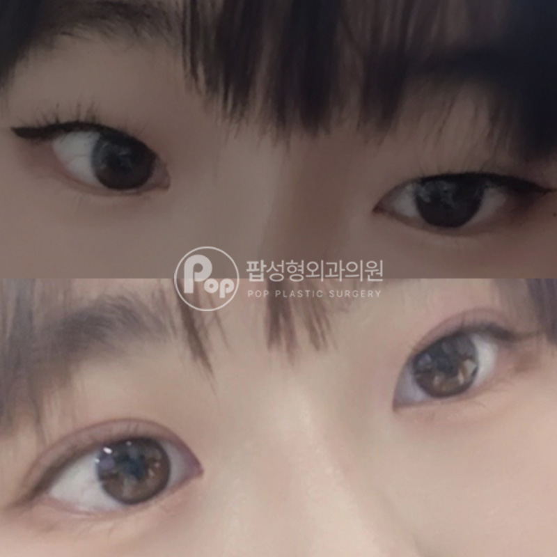 팝성형외과 무쌍 안검하수 쌍수 후기