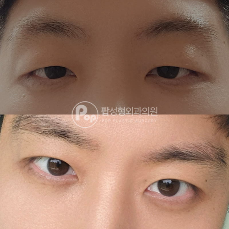 팝성형외과 졸린눈 남자눈성형 후기