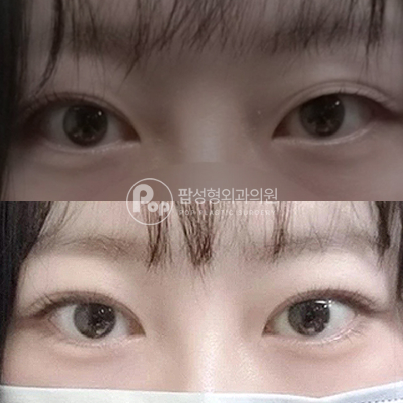 팝성형외과 눈재수술 추천 후기