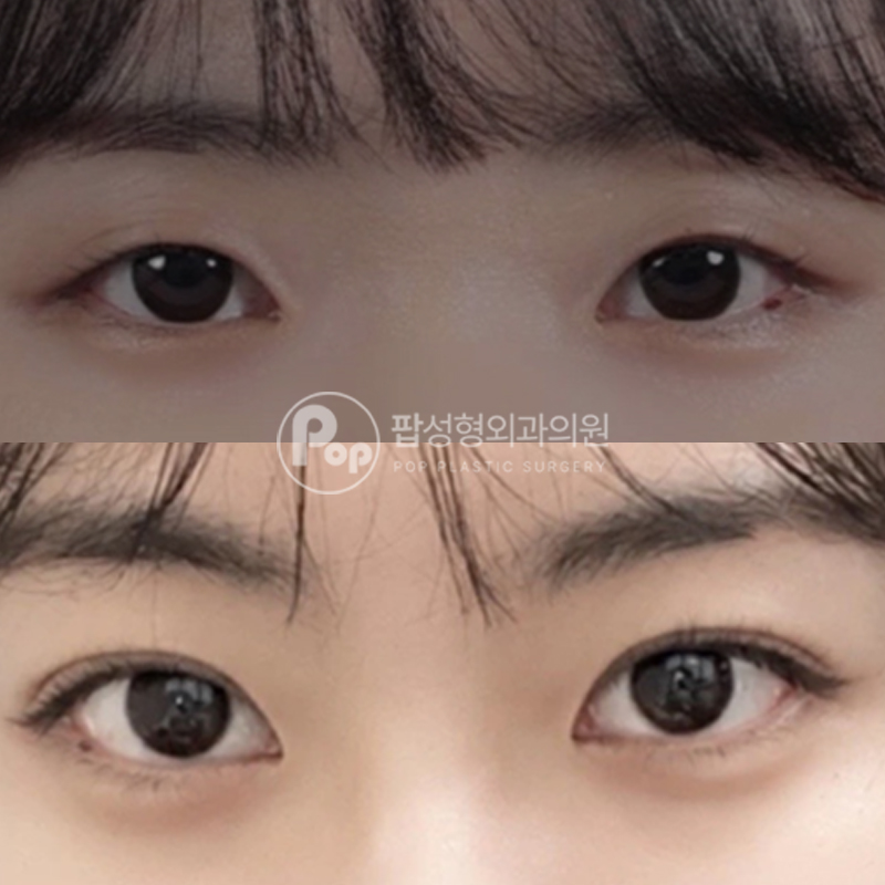 팝성형외과 인아웃라인 쌍수 눈성형 후기