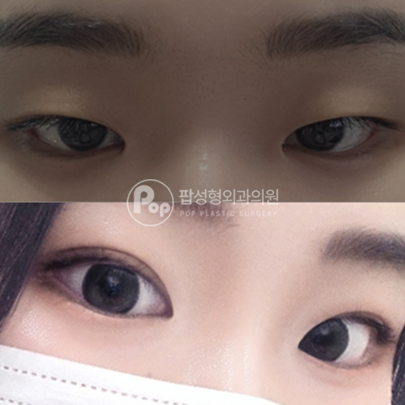 팝성형외과 안검하수 눈성형 쌍수 후기