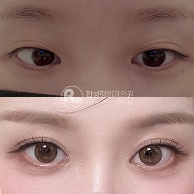팝성형외과 겹쌍꺼풀 눈재수술 후기