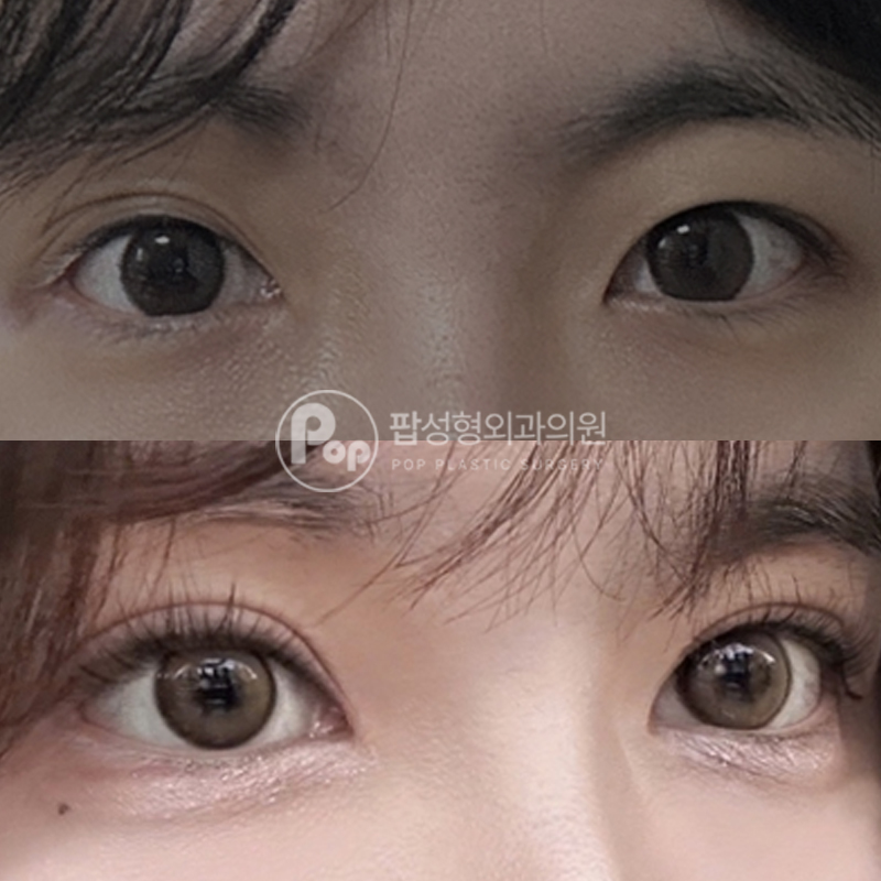 팝성형외과 비대칭라인 절개 세미아웃 후기