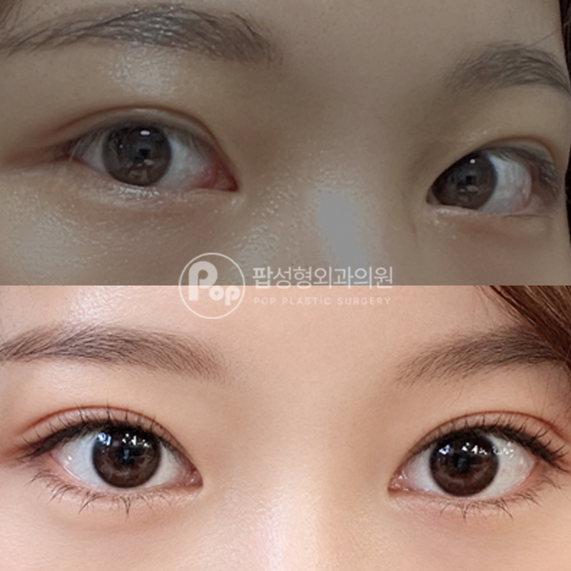 팝성형외과 눈재수술 자연유착 눈매교정 후기