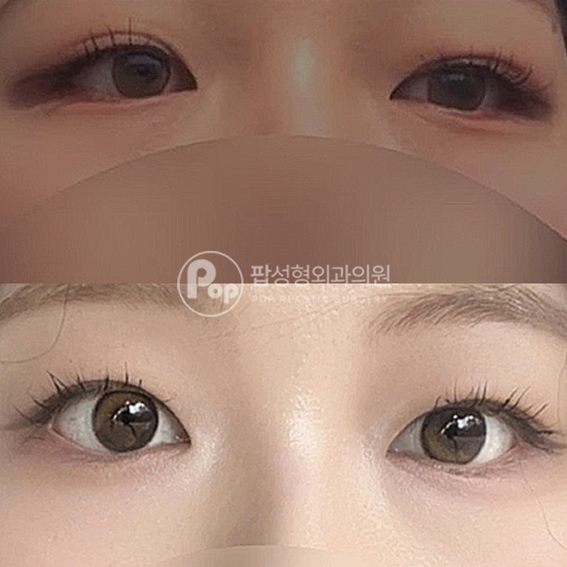 팝성형외과 절개 눈성형 후기