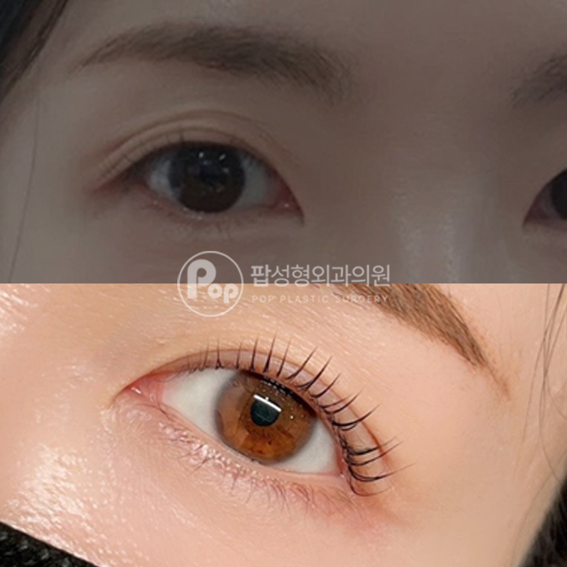 팝성형외과 겹쌍꺼풀 자연유착 후기