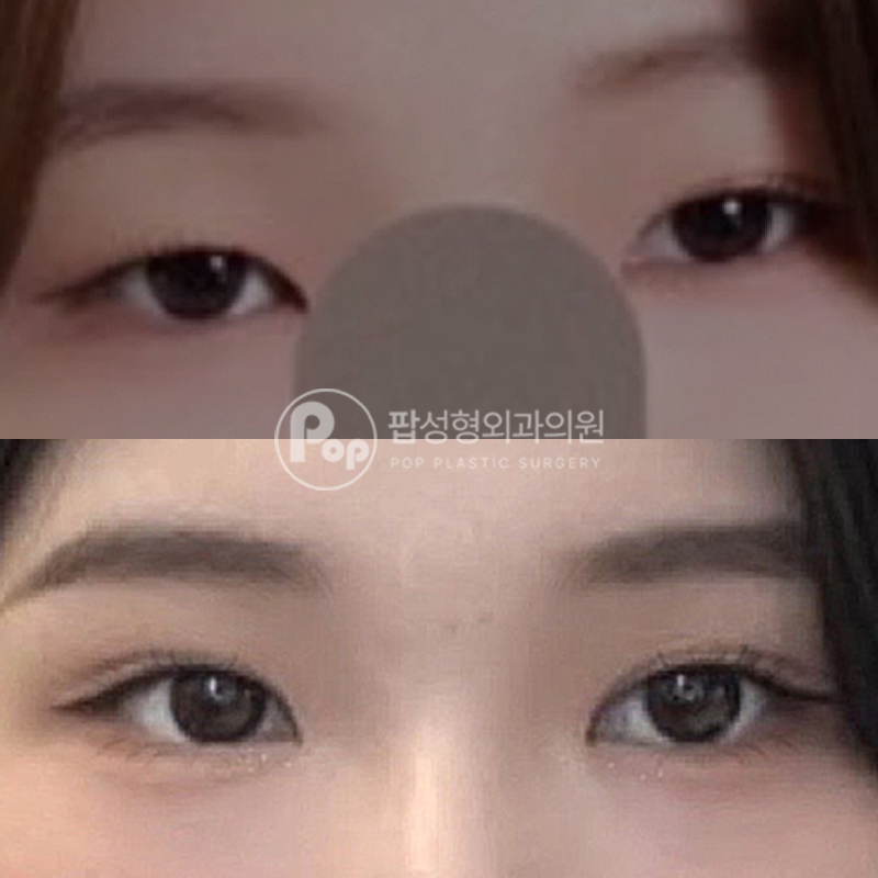 팝성형외과 풀린눈 눈재수술 후기