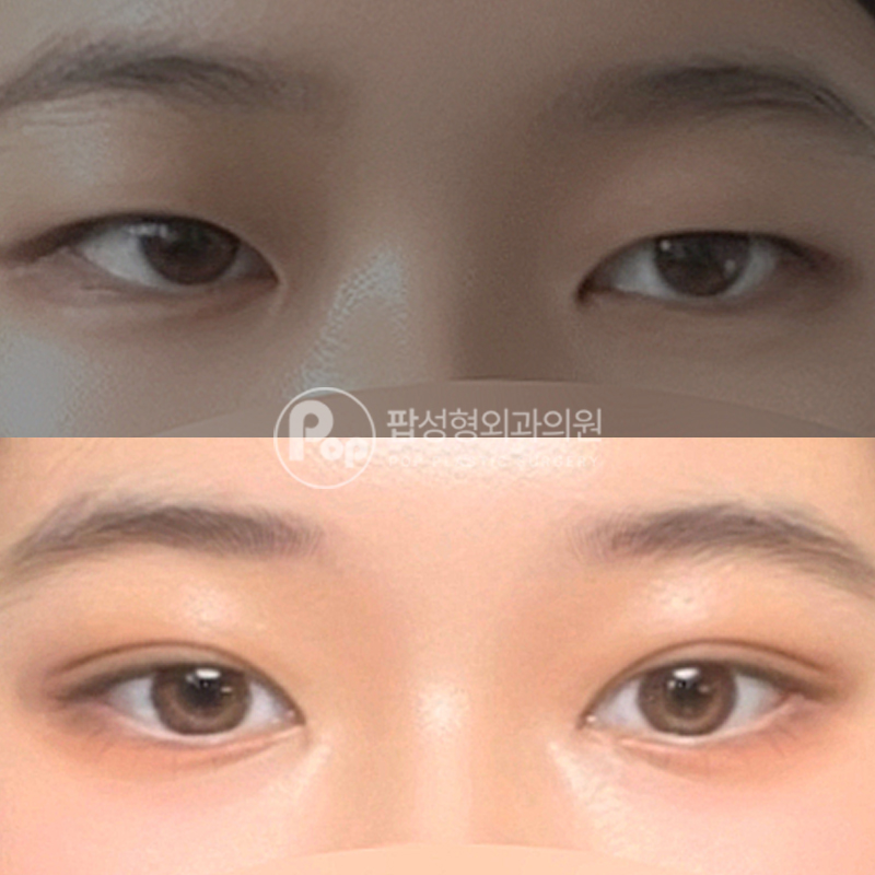 팝성형외과 무쌍 인아웃라인 매몰 후기