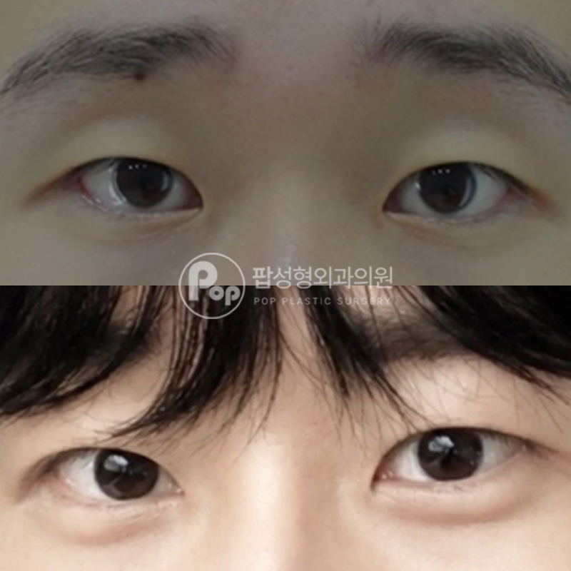 팝성형외과 남자눈성형 무쌍라인 쌍수 후기