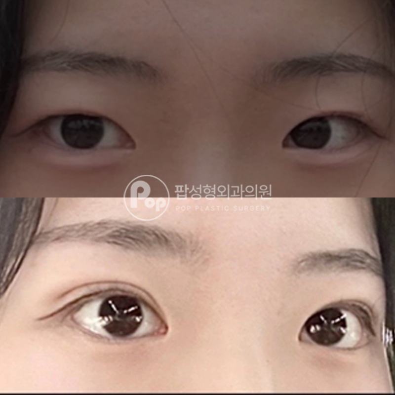팝성형외과 풀린눈 눈재수술 후기