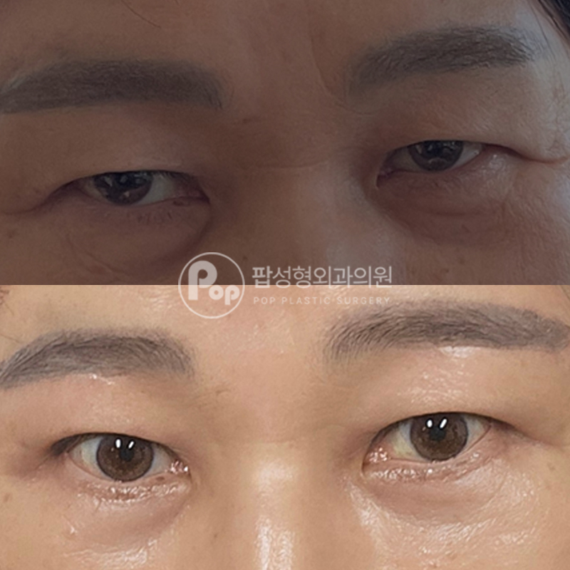 팝성형외과 중년눈성형 하안검 눈썹거상 후기