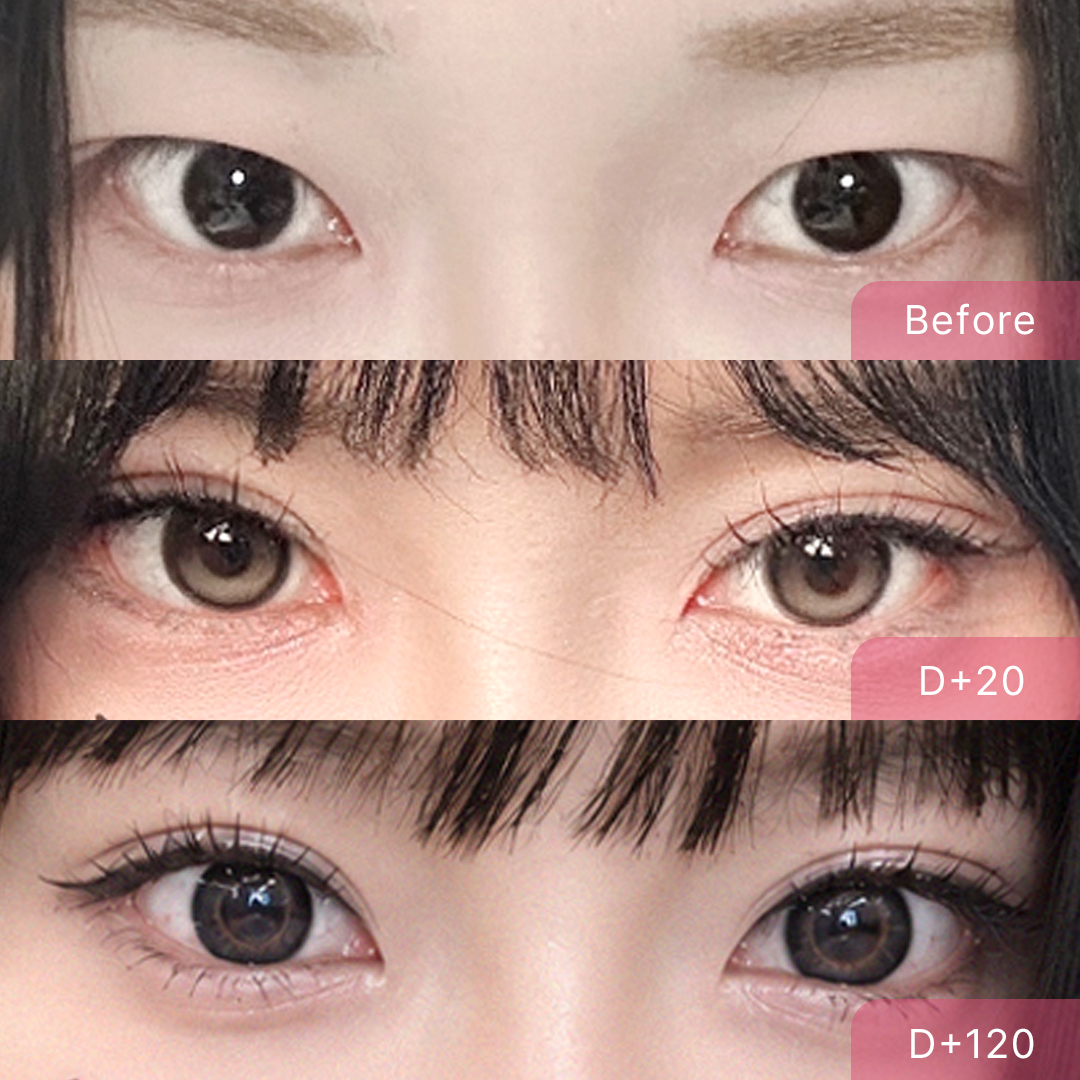 팝성형외과 사나운눈 사방트임 자연유착 경과 후기