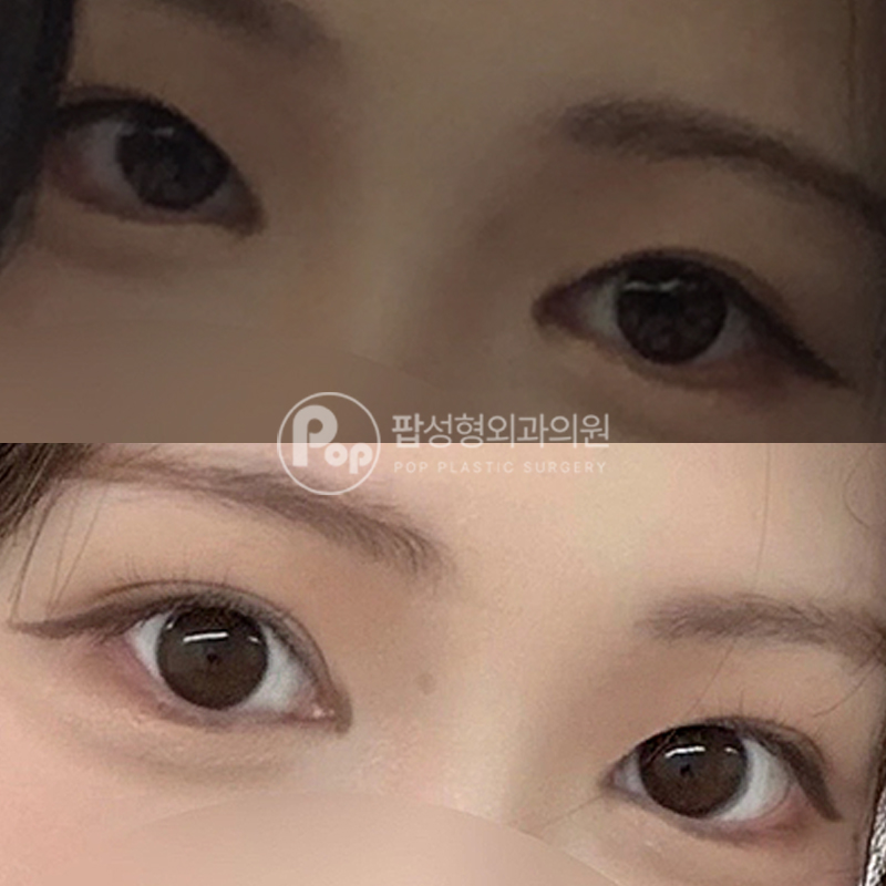 팝성형외과 풀린눈 눈재수술 후기