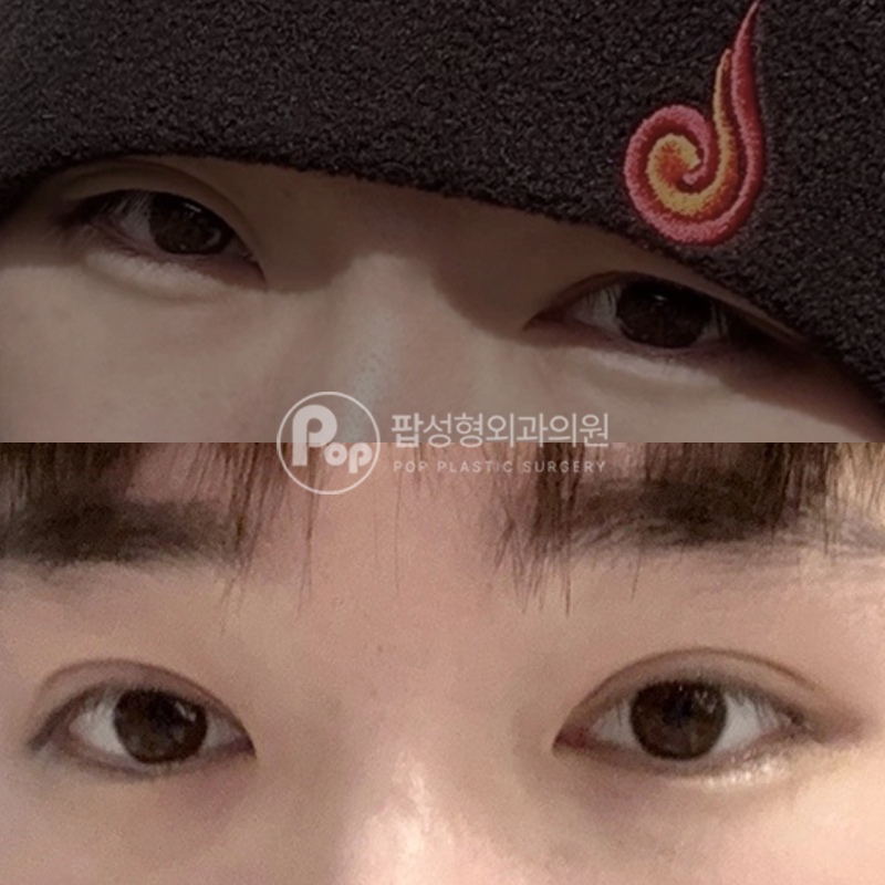 팝성형외과 남자 눈매교정 눈성형 후기