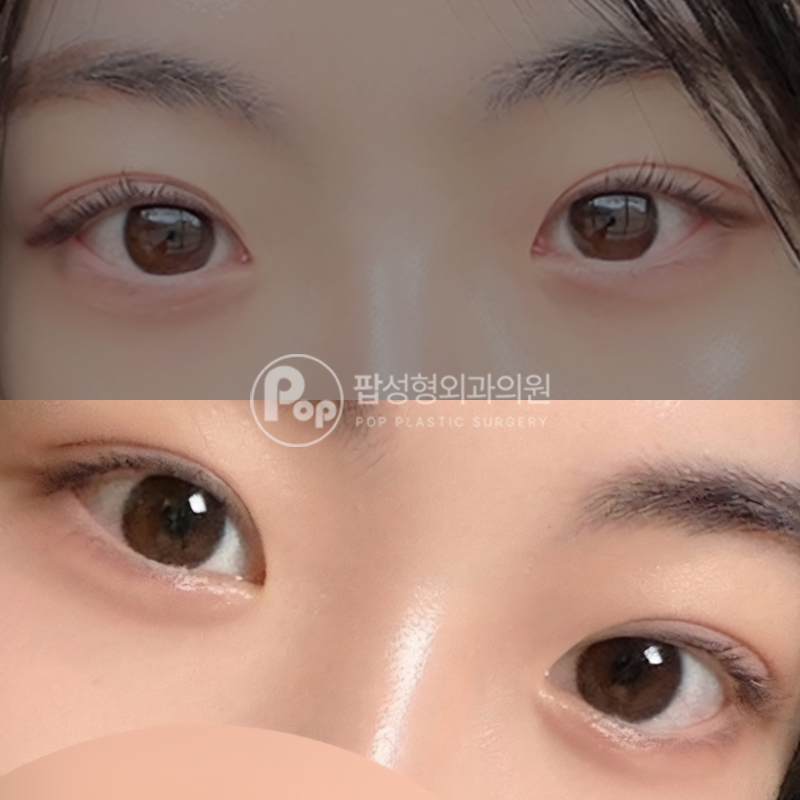 팝성형외과 짝눈 인아웃라인 자연유착 후기