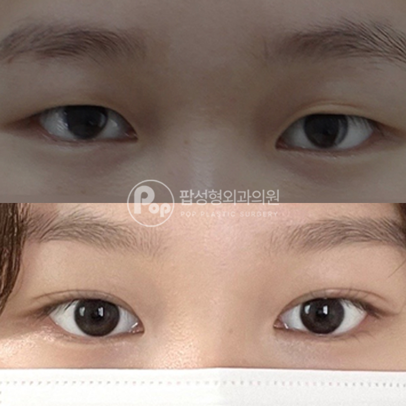 팝성형외과 무쌍에서 인아웃 자연유착 후기