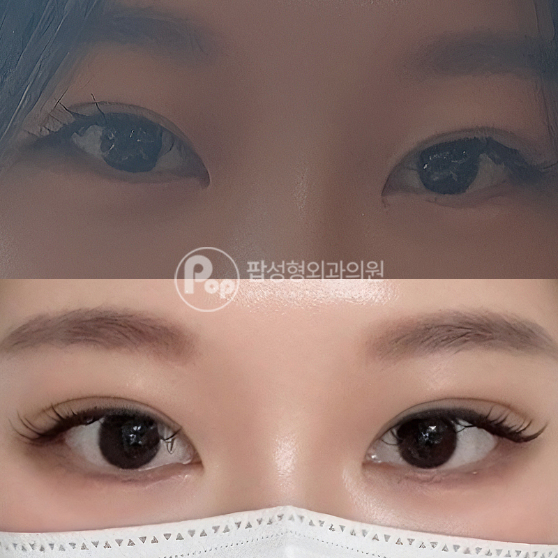 팝성형외과 비대칭라인 눈재수술 후기