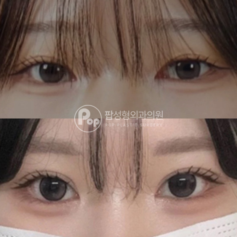 팝성형외과 풀린눈 세미아웃라인으로 눈재수술