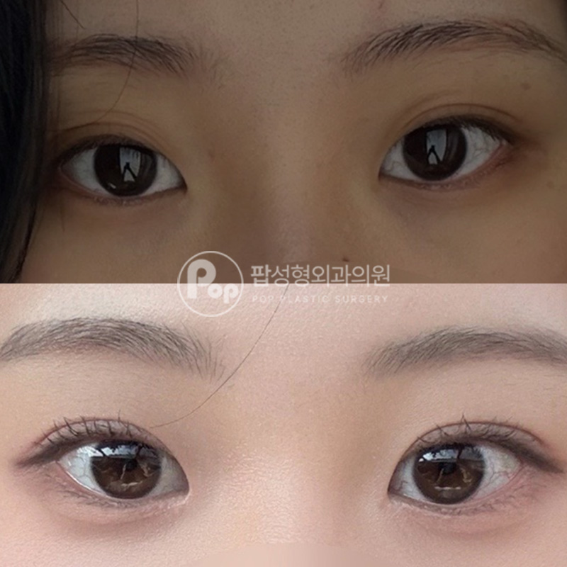 팝성형외과 꺼진눈 겹쌍꺼풀 1달차 후기