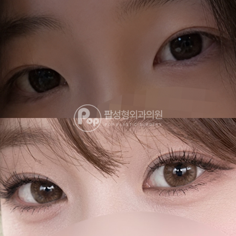 팝성형외과 쌍수 자연유착 사방트임 눈매교정 후기