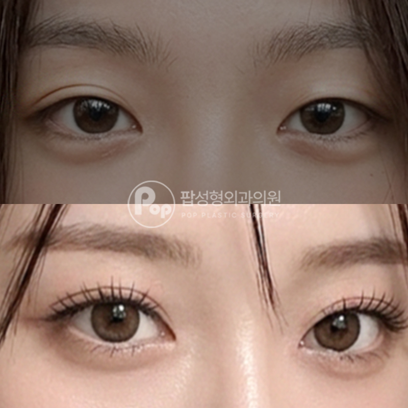 팝성형외과 아웃라인 비대칭개선 눈재수술 후기