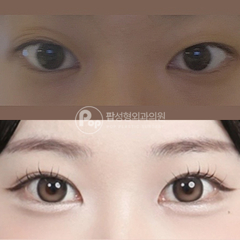 팝성형외과 짝눈 자연유착 후기