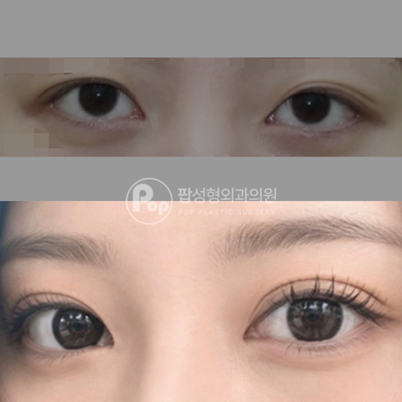팝성형외과 자연스러운 세미아웃 쌍수 후기