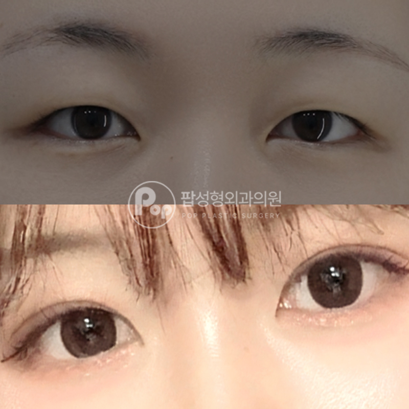 팝성형외과 무쌍 자연유착 후기