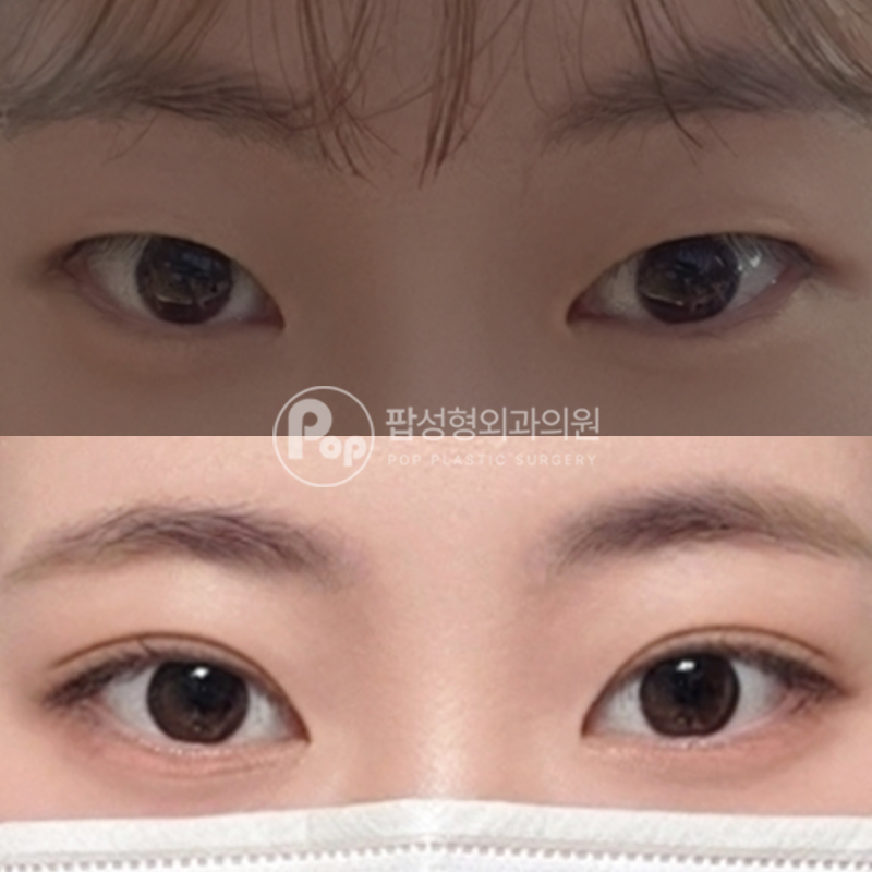 팝성형외과 무쌍 자연유착 쌍수 후기