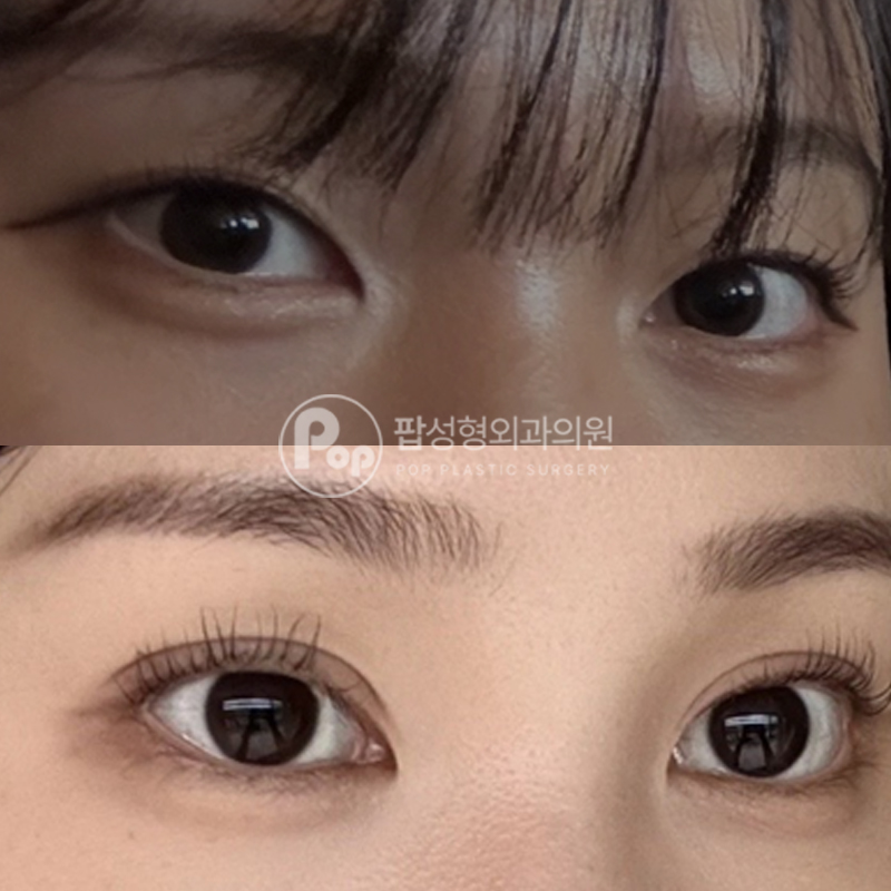 팝성형외과 세미아웃라인 눈재수술 후기