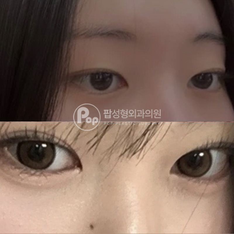 팝성형외과 인아웃라인 후기 매몰 눈매교정