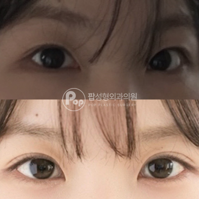 팝성형외과 인아웃 자연유착 트임 눈성형 후기