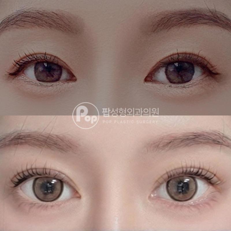 팝성형외과 처진눈 눈재수술 자연유착 후기