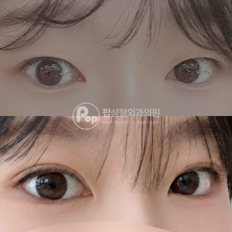 팝성형외과 처진눈 자연유착 쌍수 후기