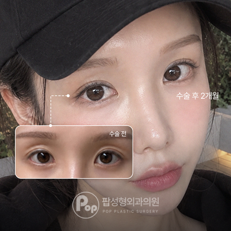 팝성형외과 돌출눈 두줄따기 눈재수술 2개월차 후기