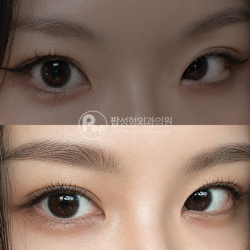 팝성형외과 짝눈, 풀린라인 자연유착 후기
