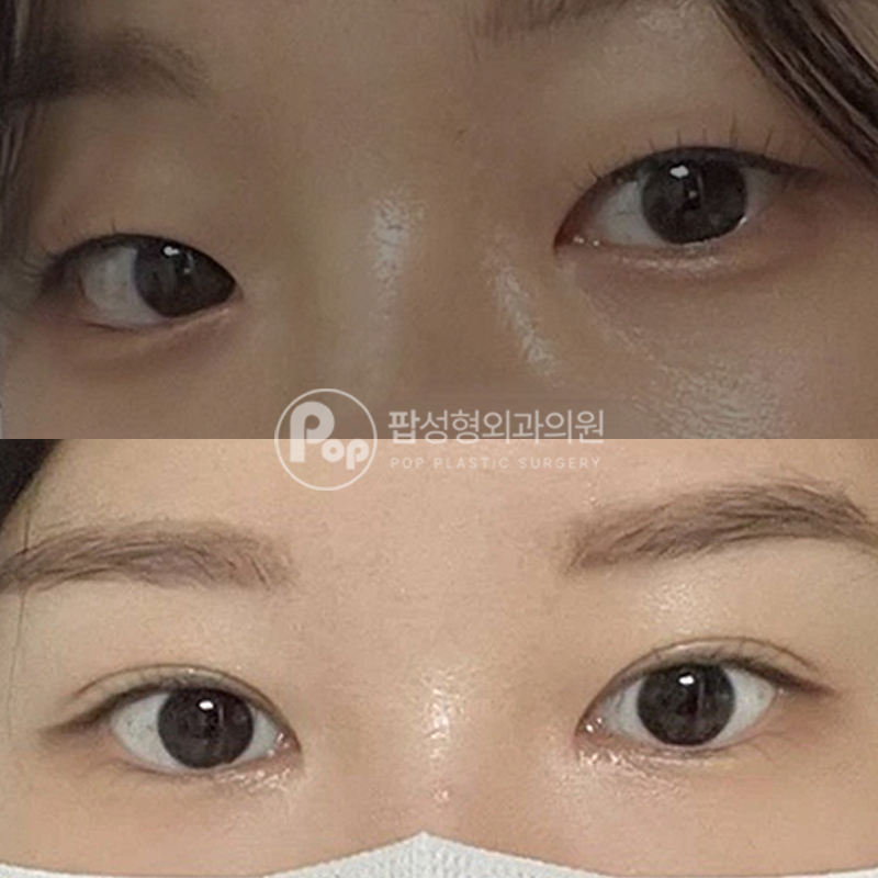 팝성형외과 무쌍 인아웃 후기