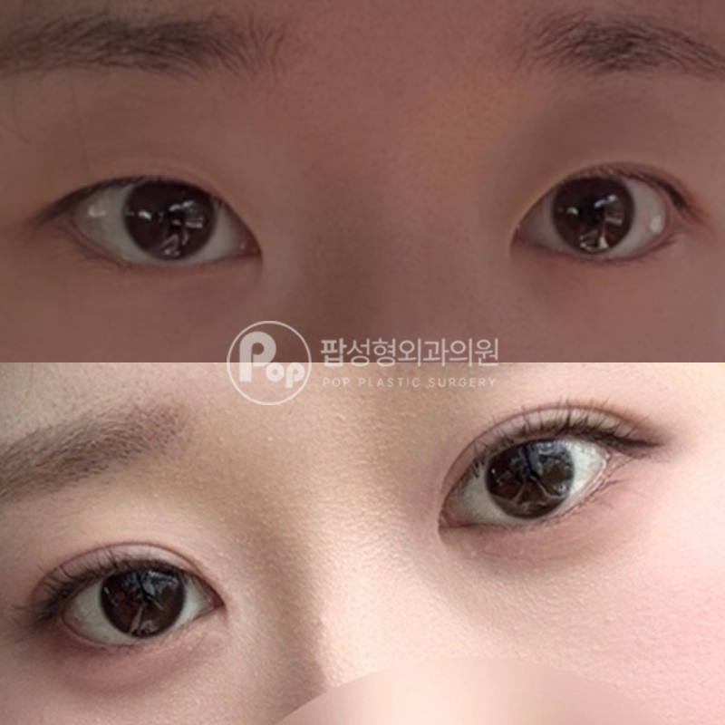 팝성형외과 풀린 라인 눈재수술 후기