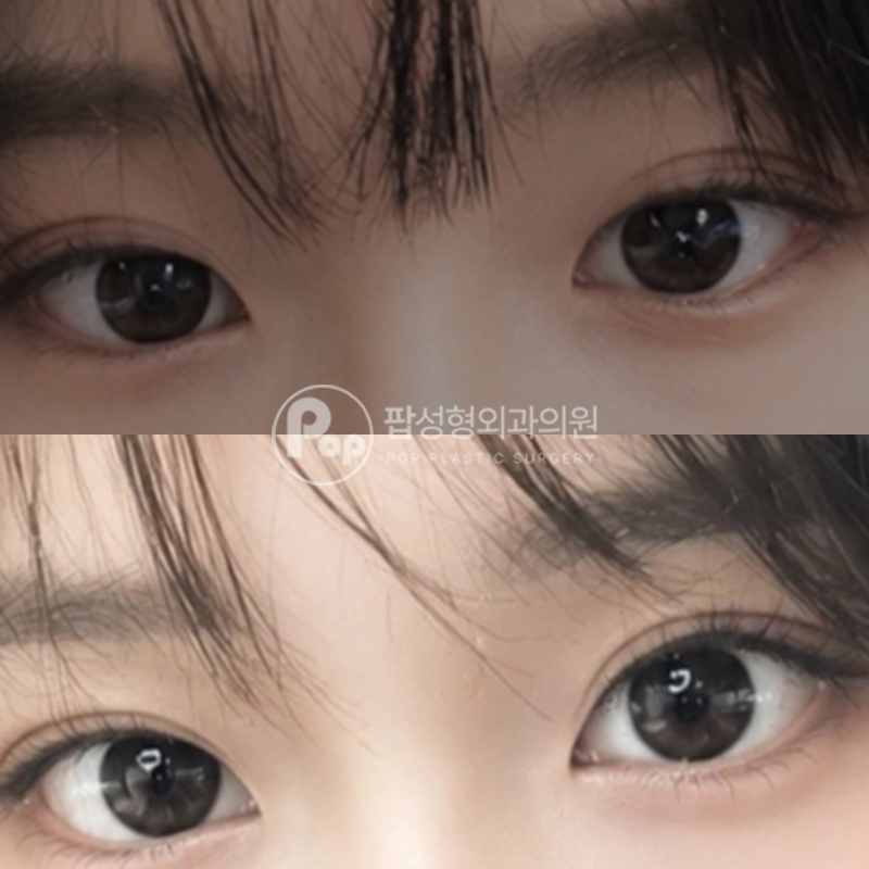 팝성형외과 뒤밑트임 눈성형 후기