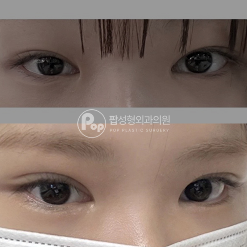 팝성형외과 라인높이기 눈재수술 후기