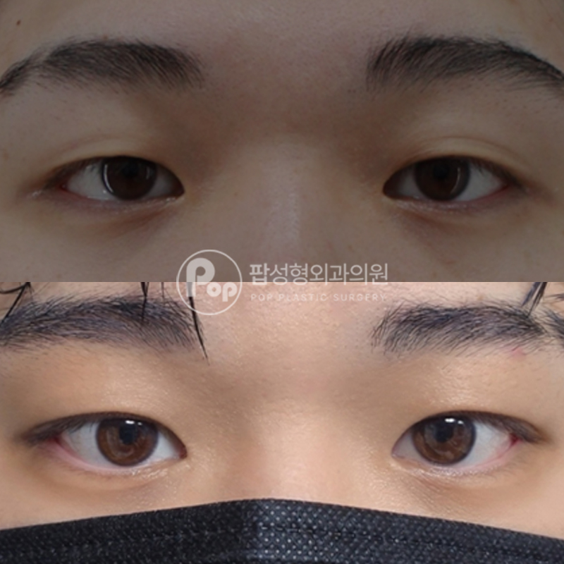 팝성형외과 남자눈성형 눈매교정 후기