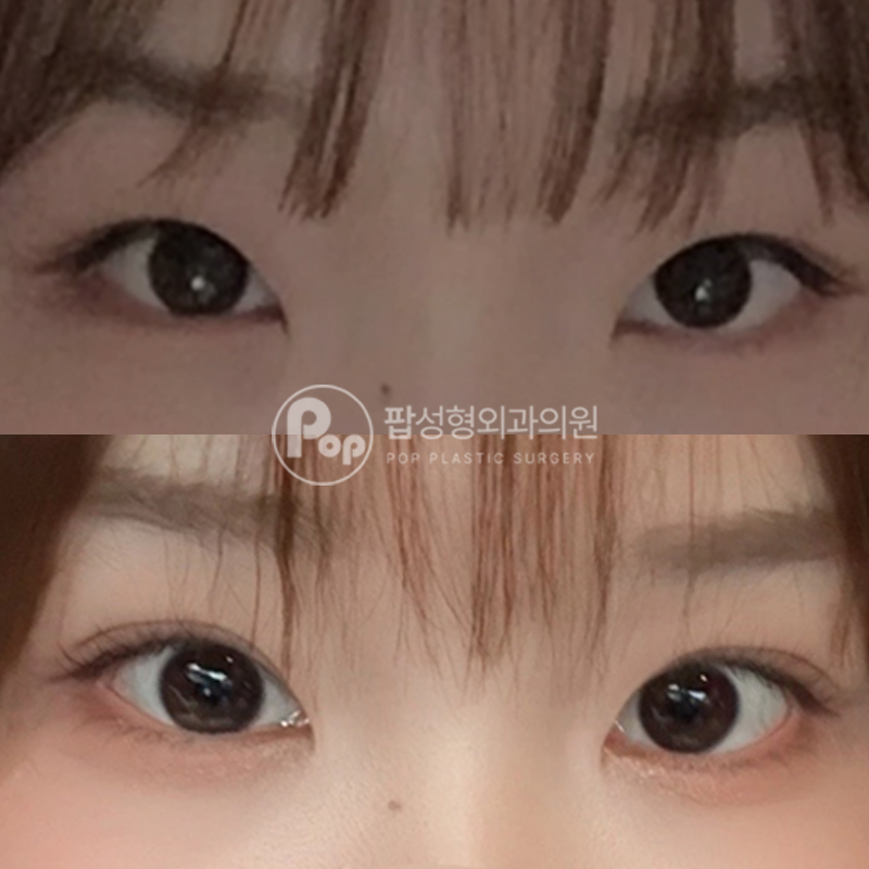 팝성형외과 트임, 쌍수 자연유착 눈성형 후기
