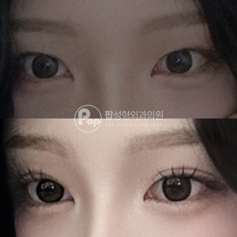 팝성형외과 쌍꺼풀 풀림·짝눈·라인 비대칭 눈재수술