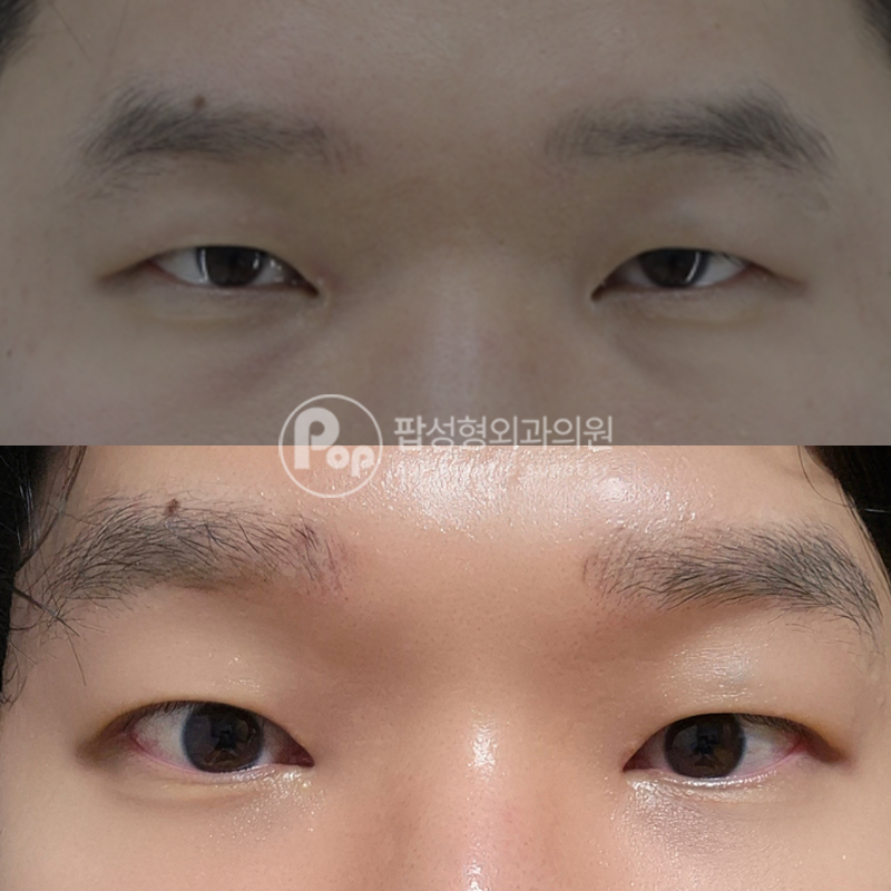 팝성형외과 남자 이마거상 실제 후기