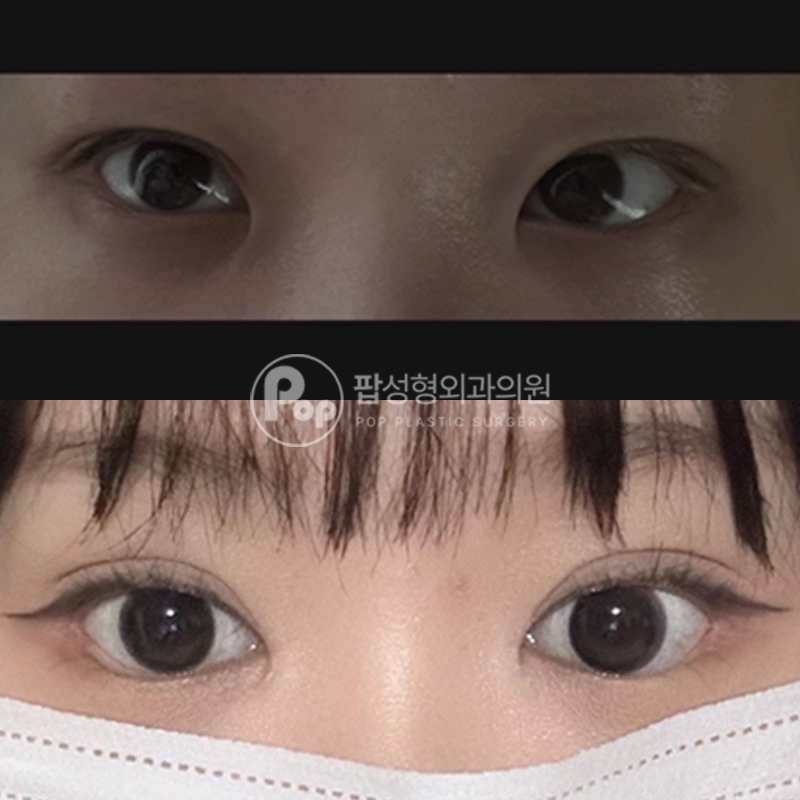 팝성형외과 풀린눈 눈재수술 후기