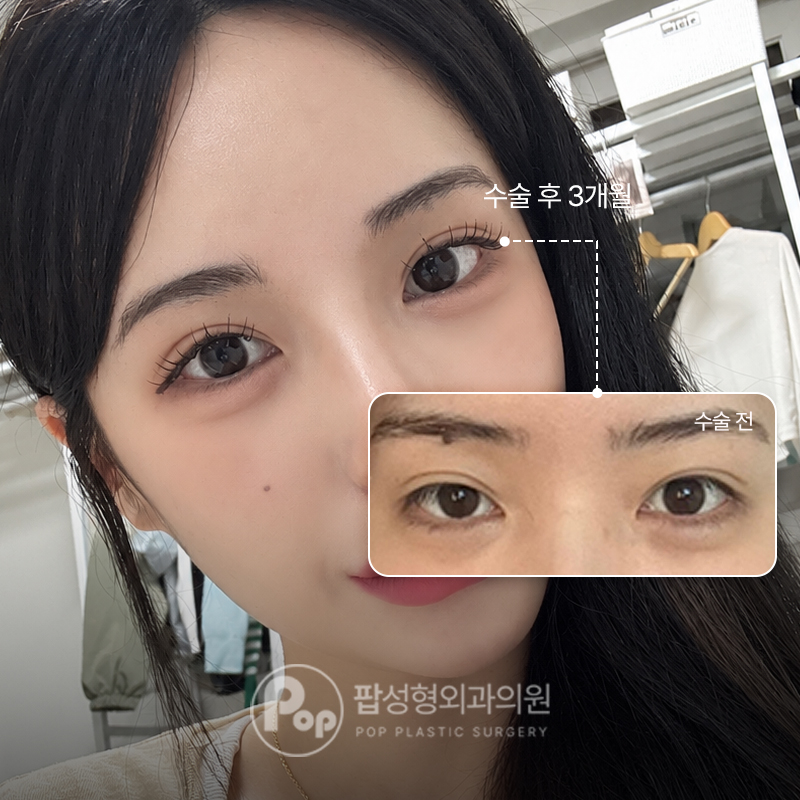 팝성형외과 소세지라인 눈재수술 트임 후기