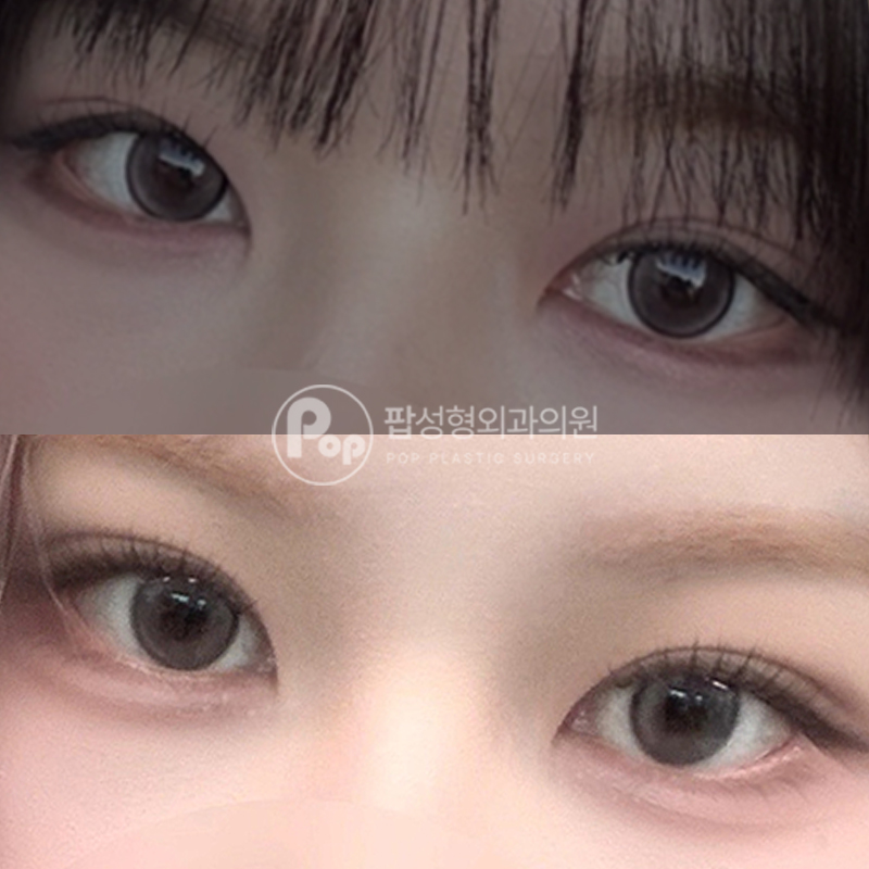 팝성형외과 쌍수 눈성형 후기