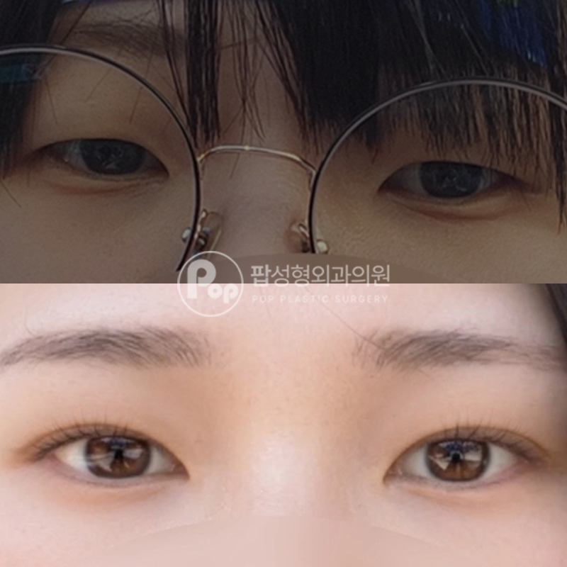 팝성형외과 자연유착 안검하수 쌍수 후기