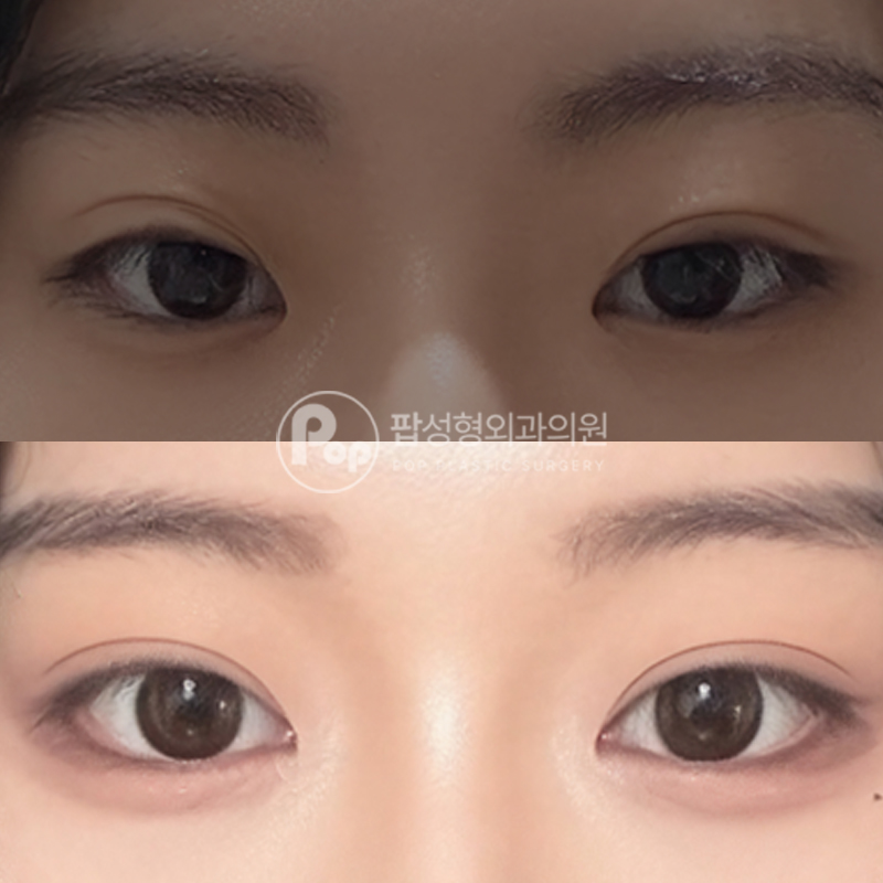 팝성형외과 인아웃라인 눈재수술 후기